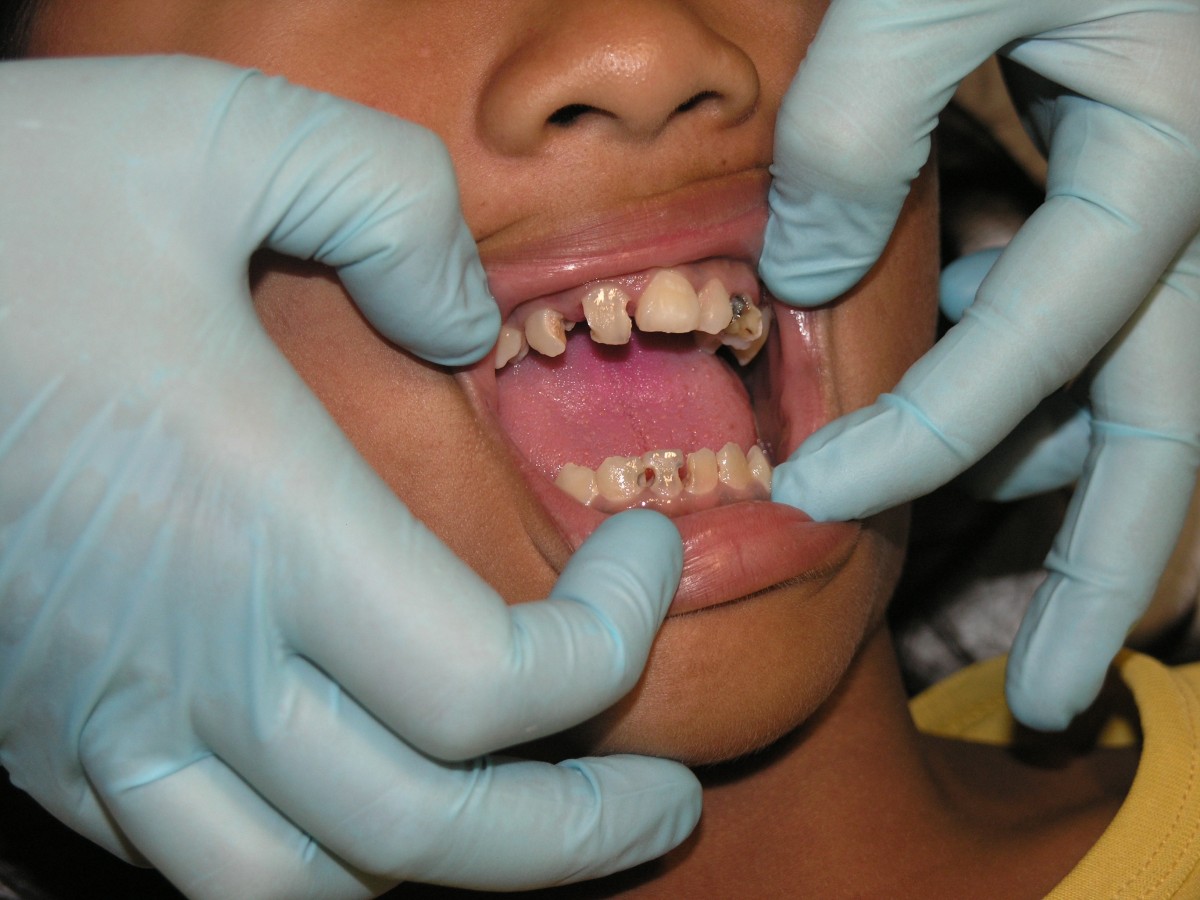 Soigner un abcès dentaire naturellement